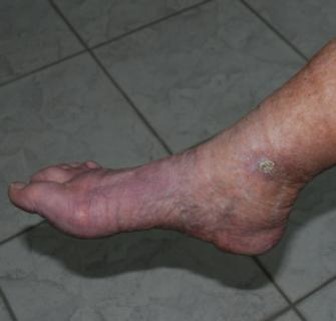 A close-up shot of ankle and leg After treatment