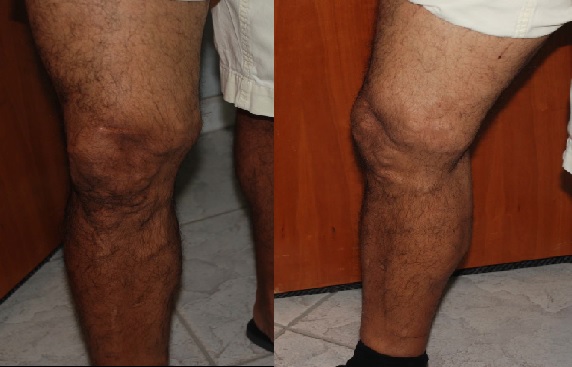 A close-up shot of before and After treatment