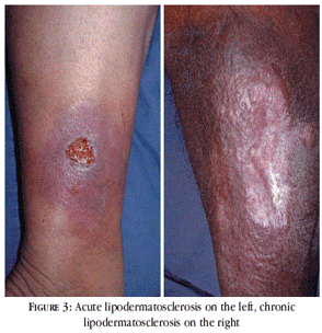 A close-up shot of lipodermatosclerosis on right