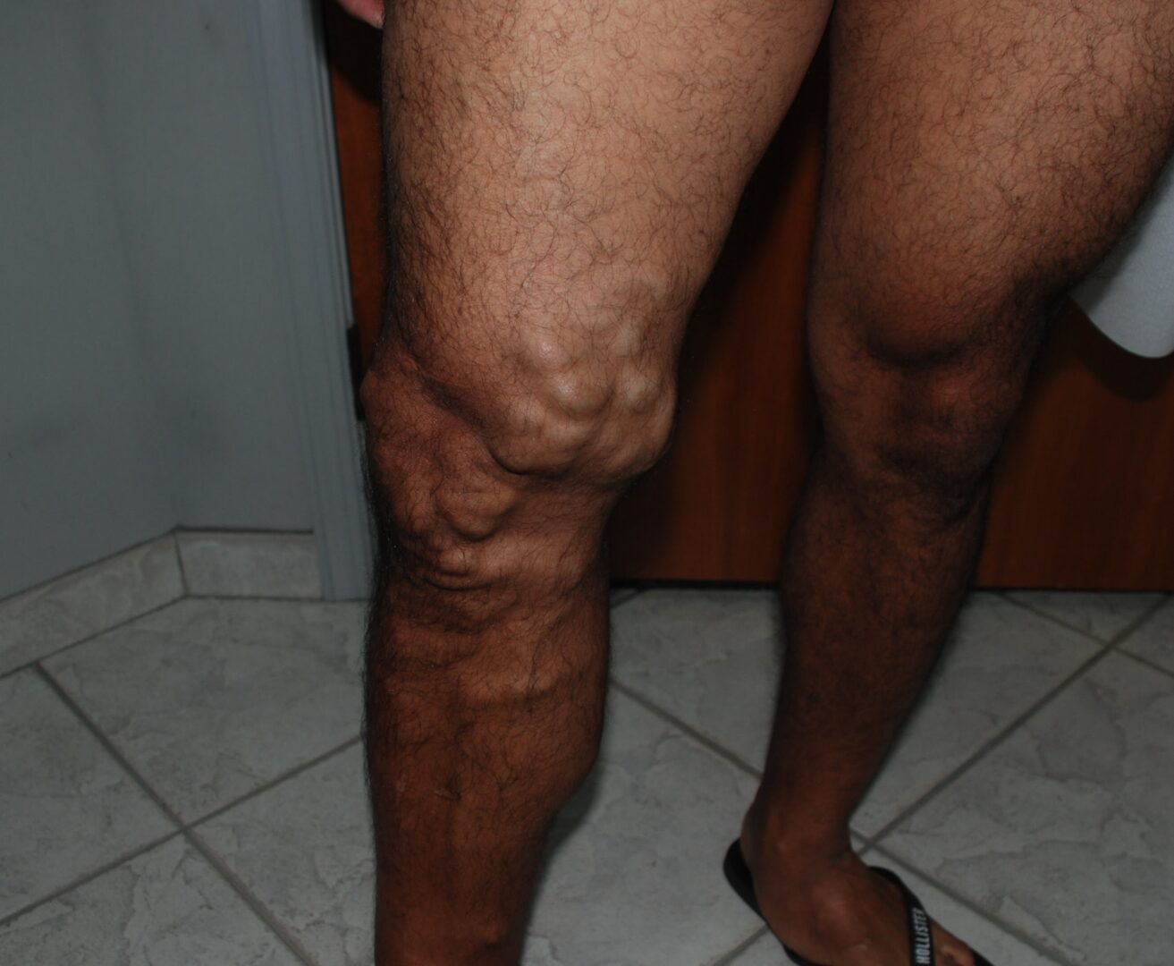 A Person Showing Bruises In Leg