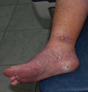 A close-up shot of ankle and feet before treatment