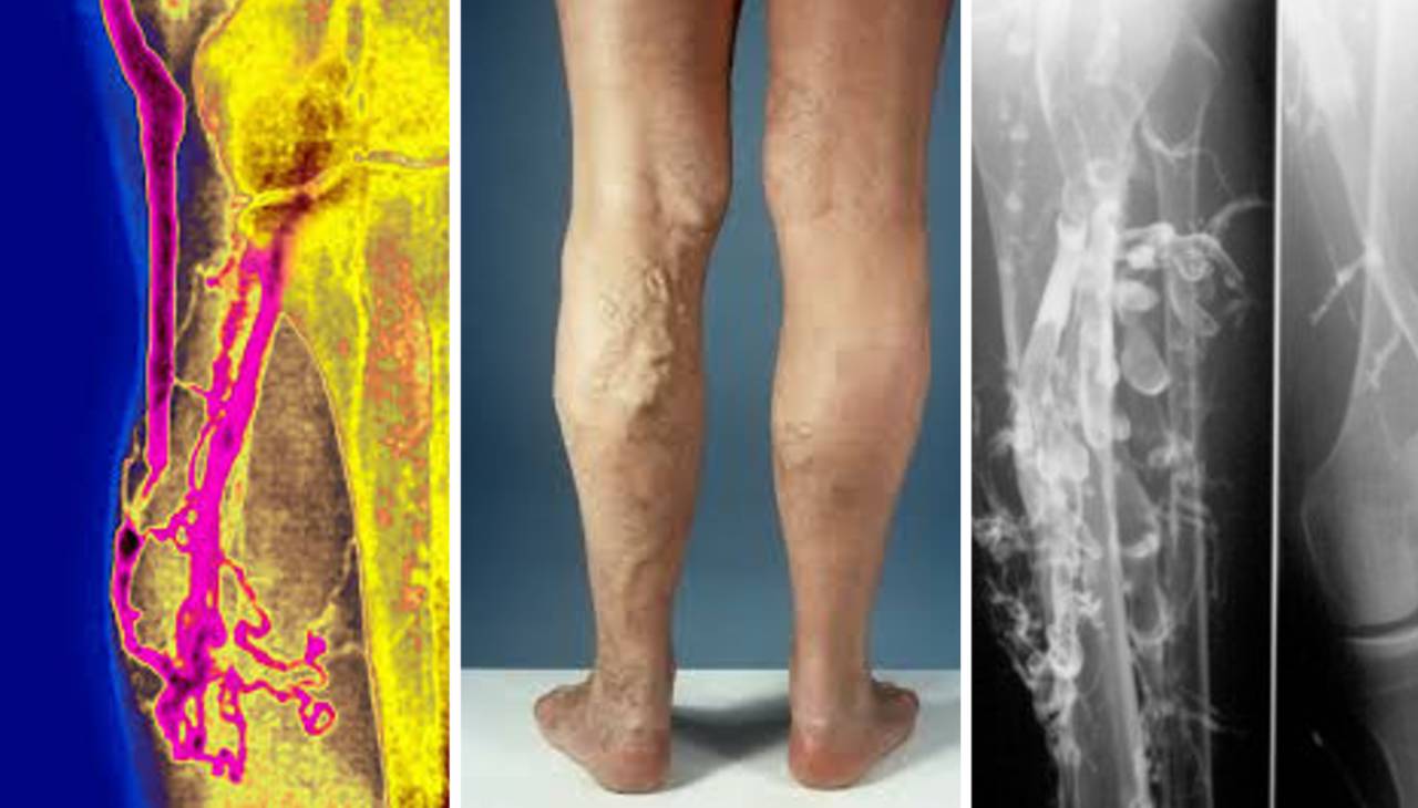 X - rays of a woman's leg and a man's leg taken at Deak Vein NJ Clinic in Millburn, NJ.