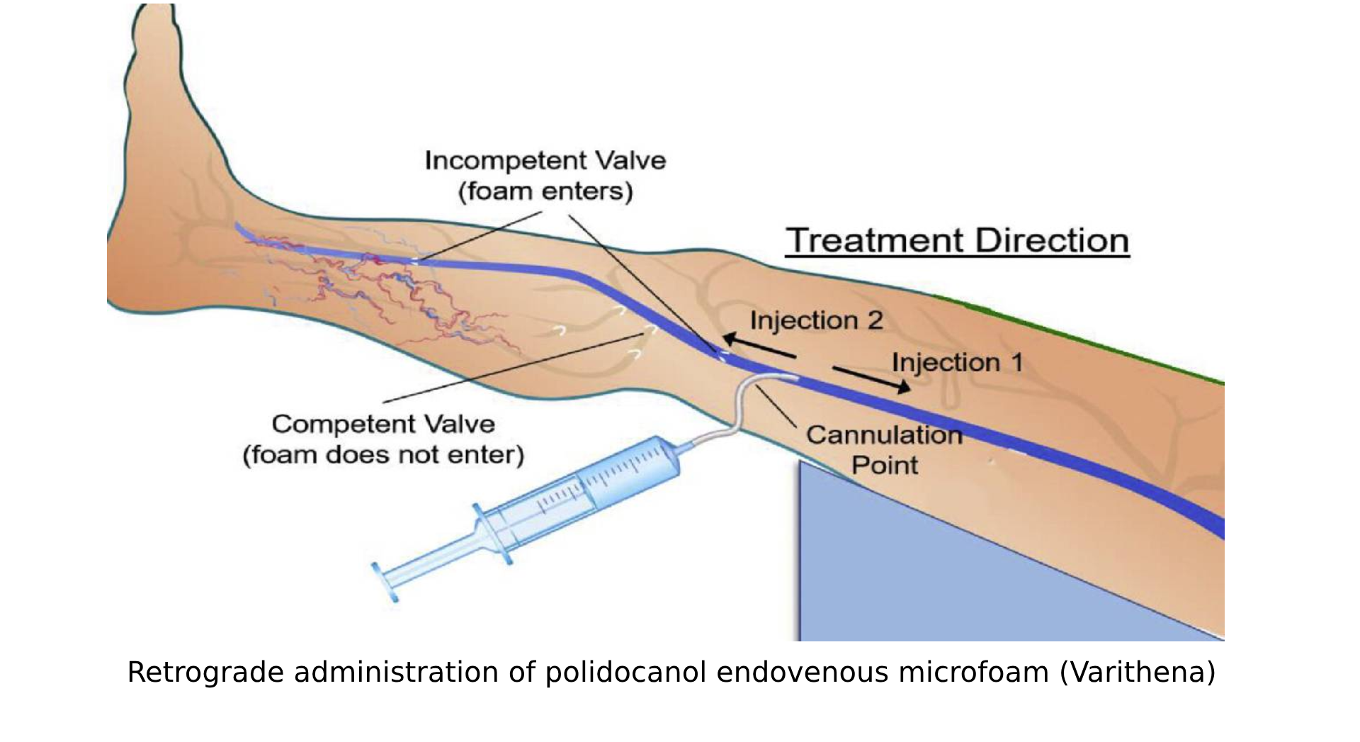 A diagram showing the treatment of a patient's arm at Deak Vein NJ Clinic located in Somerset, NJ.